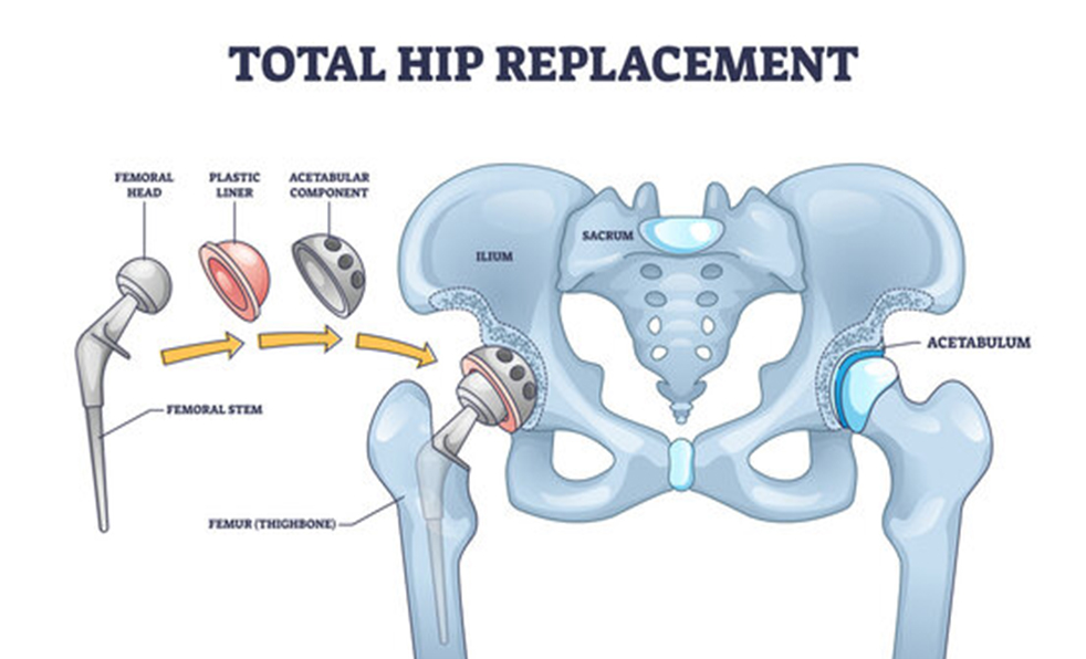 Hip Replacement Surgeons in Shivaji Nagar