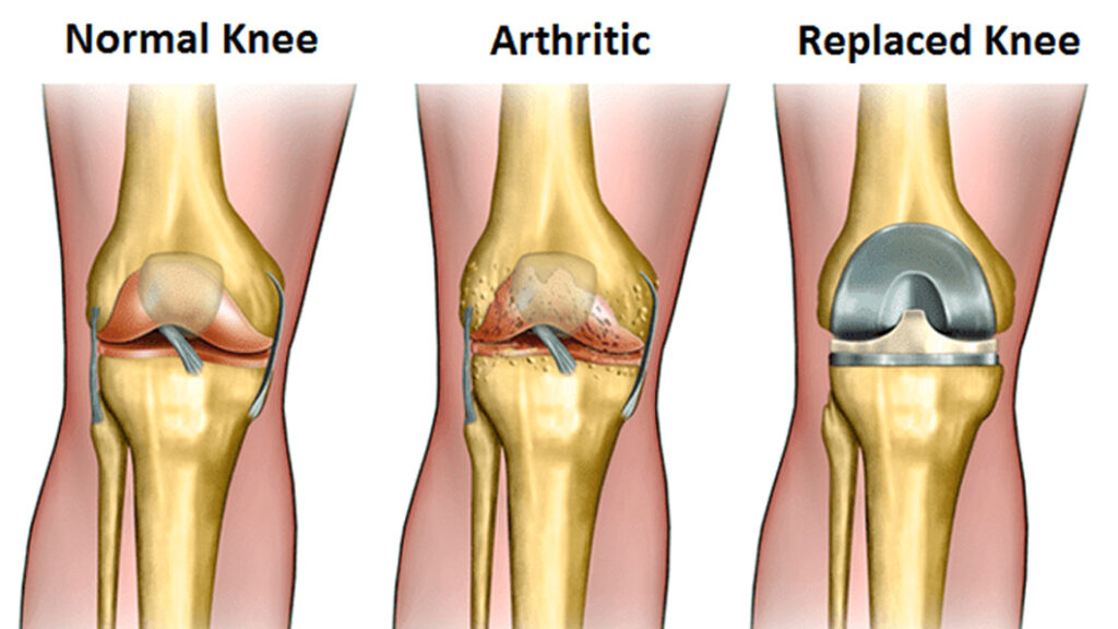 Robotic Total Knee Replacement in Shivaji Nagar