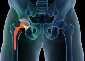 Different Types Of Hip Replacement Surgeries – What To Know Before Choosing