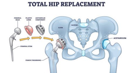 Hip Replacement Surgeons in Shivaji Nagar