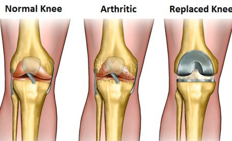 Robotic Total Knee Replacement in Shivaji Nagar